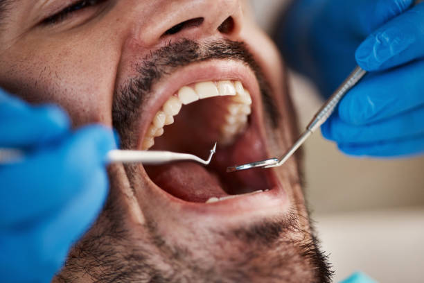 Best Emergency Dental Extractions in Hemet, CA